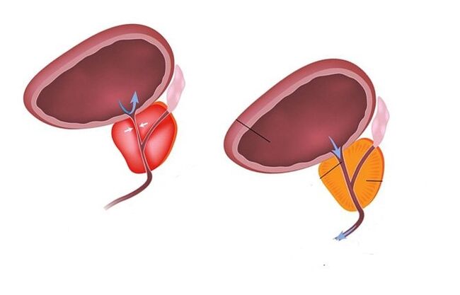 zdrave i bolesne prostate