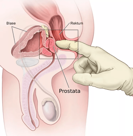 Masaža prostate