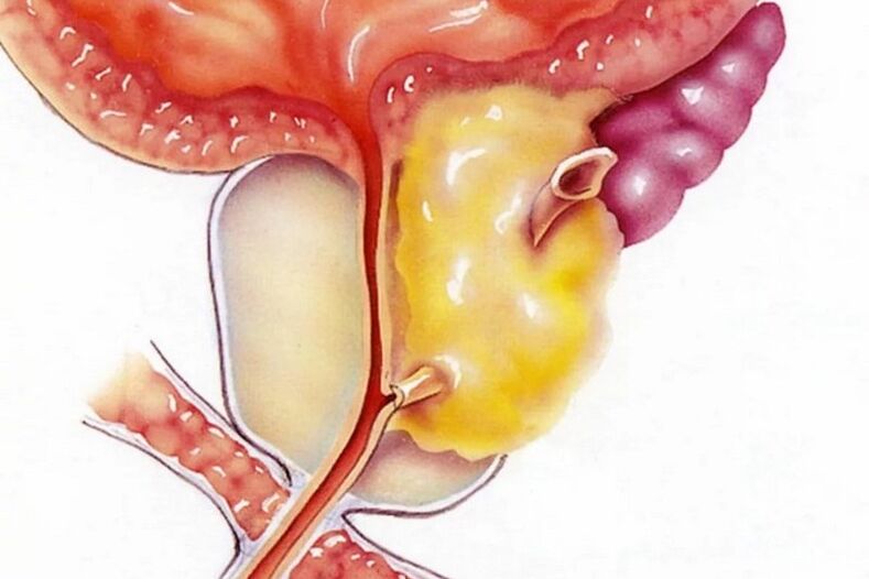 Upala prostate